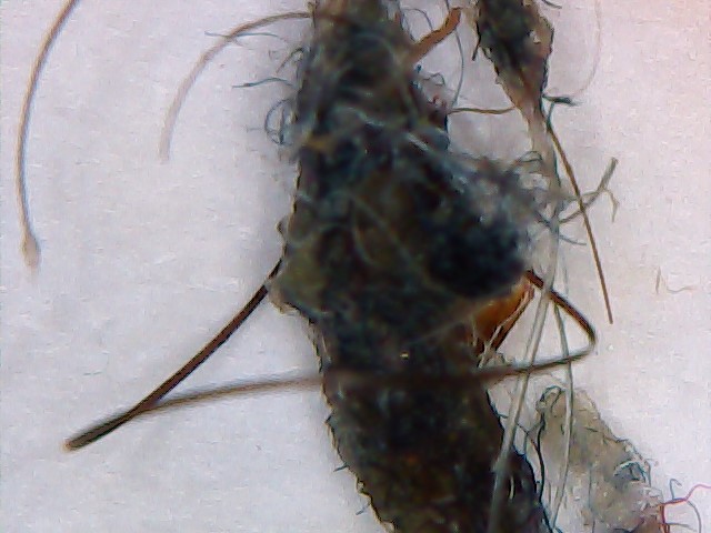 Morgellons Disease What Is it? - Highly Contagious It's A pandemic!!
Morgellons Disease Is A Fungi, Shingles & Lyme Disease Is Morgellons
Morgellons Disease is A Fungi