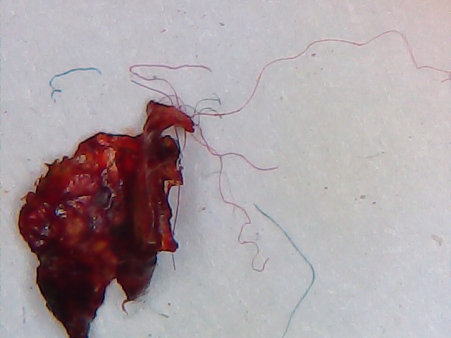 What is Morgellons Disease The Silent Pandemic? Morgellons is a fungi (aspergillus fumigatus)