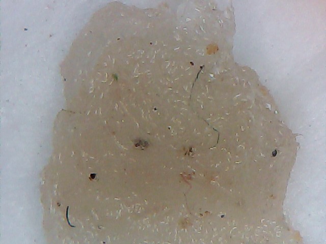 Morgellons Disease The Silent Pandemic - The evolution from the gooey film to threads