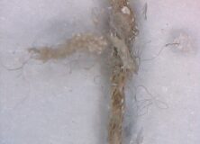 Aspergillus Fumigatus & Morgellons Disease: The Silent Pandemic –   Undecylenic Acid out of stock
